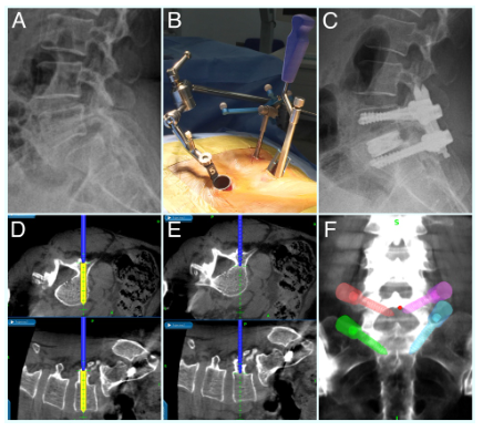 The images of the spine during the minimally invasive treatment procedures.