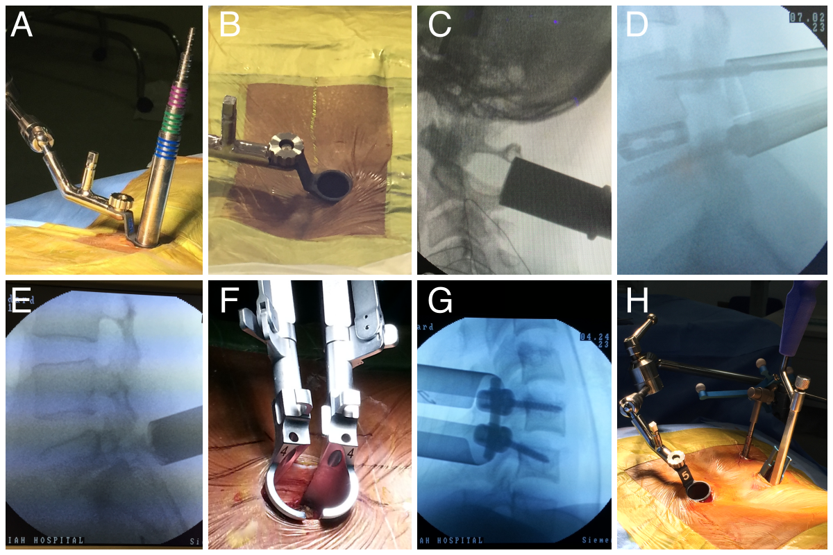 The images of the spine during the minimally invasive treatment procedures.