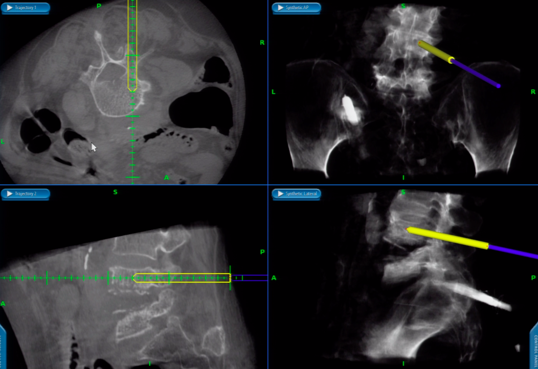 The images of the spine during the minimally invasive treatment procedures.