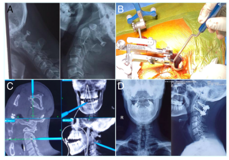 Medical images of the spine during the minimally invasive treatment procedures.