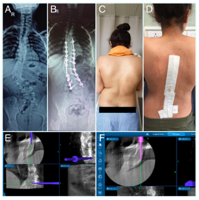 The images of the spine during the minimally invasive treatment procedures.