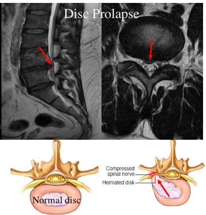 The images of the spine during the minimally invasive treatment procedures.