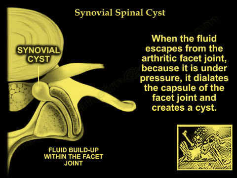 The images of the spine during the minimally invasive treatment procedures.