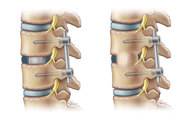 A doctor is performing a fusion surgery for the spine problem.